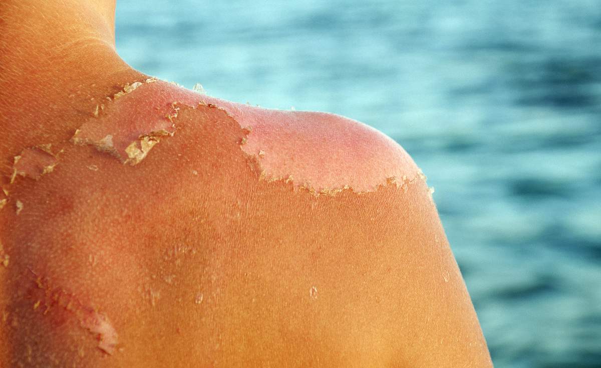 Dermatitis Solaris, besser bekannt als der gemeine Sonnenbrand